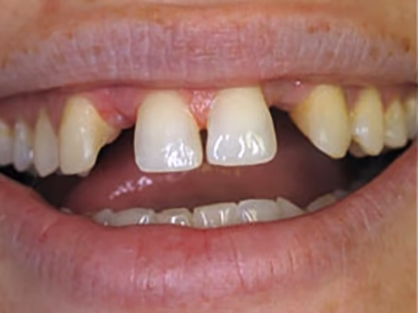 Before — two 3-unit bridges replacing missing teeth