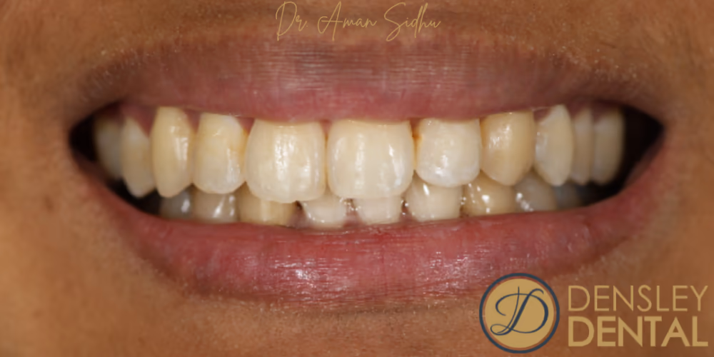 Invisalign result
