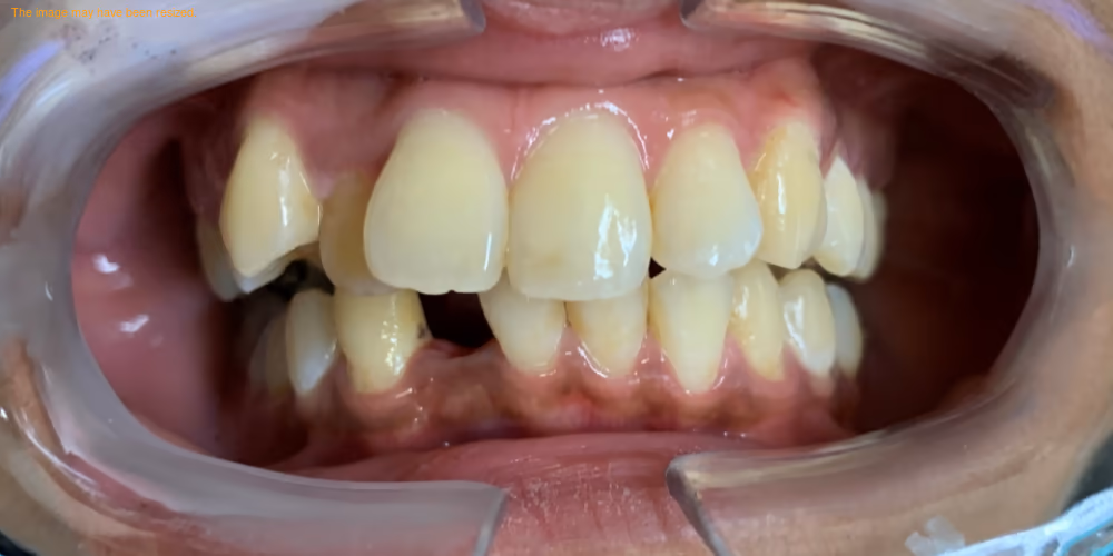 Before — Invisalign treatment