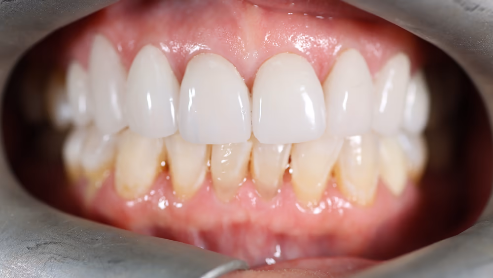 Porcelain veneers result