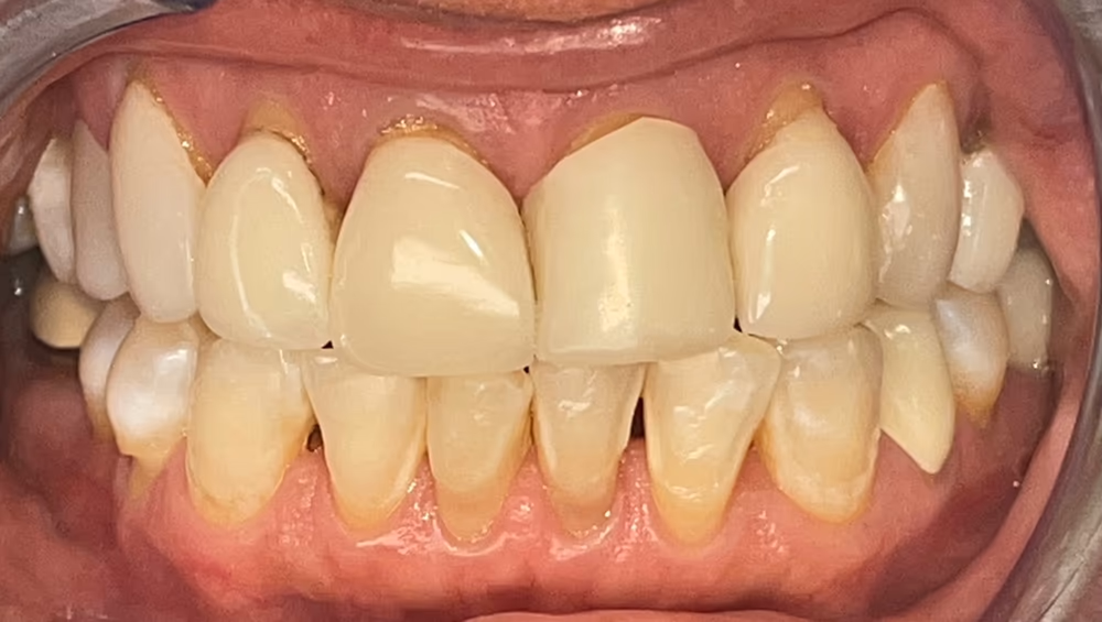 Before — 8 upper veneers replacement
