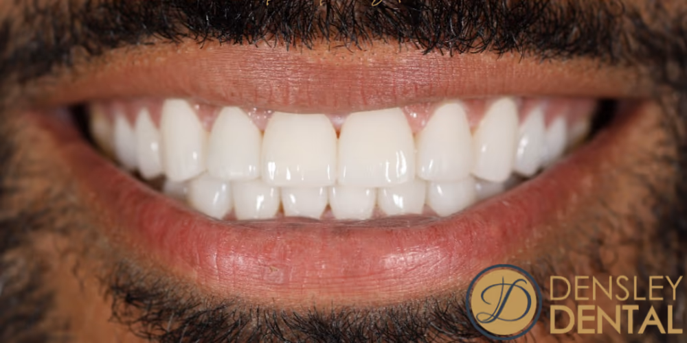 Veneers