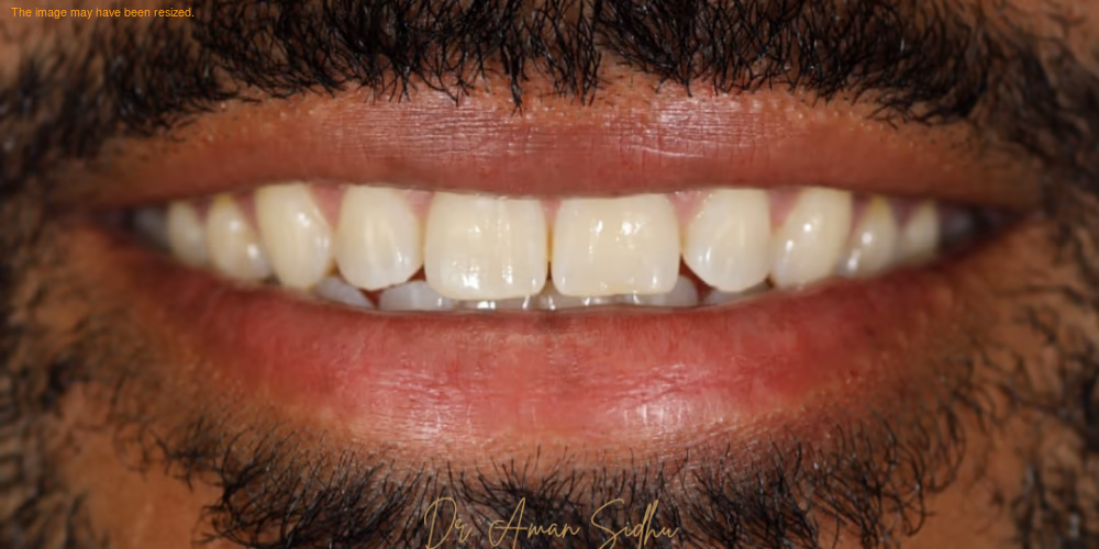 Before — 10 veneers on top and 10 on the bottom