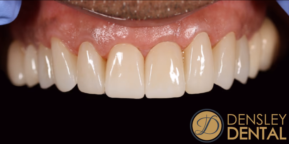 After — 8 upper veneers
