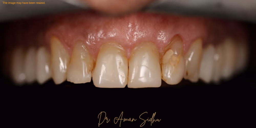 Before — 8 upper veneers