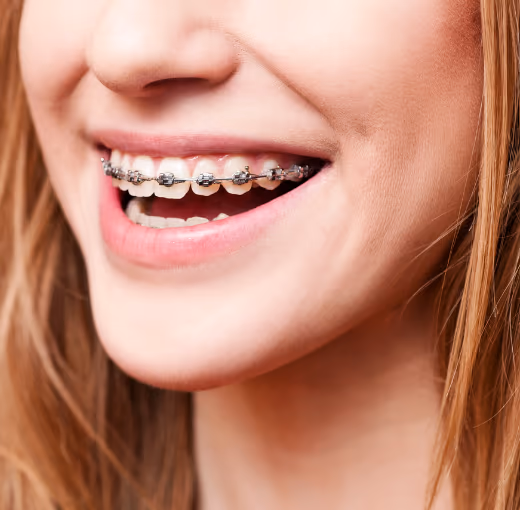 Braces at Densley Dental in Henderson NV