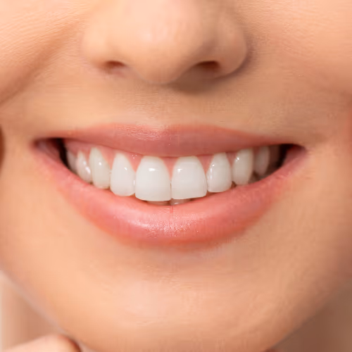Teeth Whitening at Densley Dental in Henderson NV